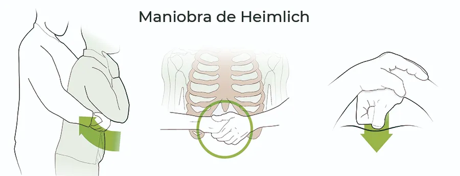 MANIOBRA DE HEIMLICH<br />
